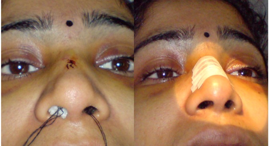 Операция или травмирование носа