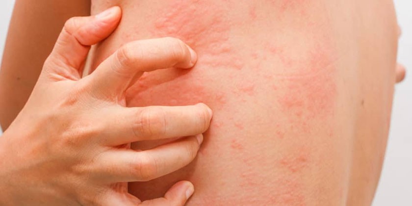 Иммуноаллергическая патология кожи