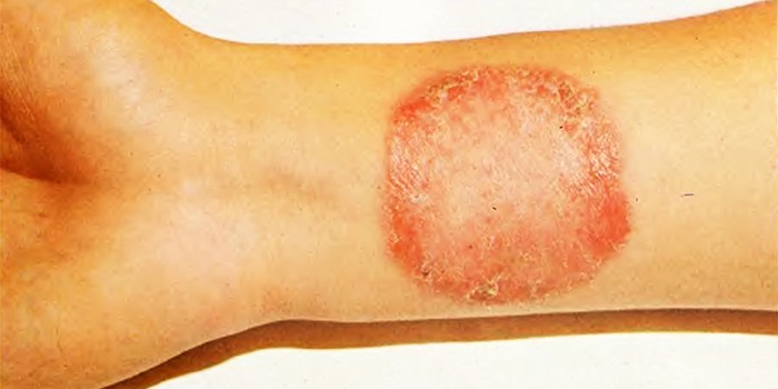При вирусных или грибковых заболеваниях кожи