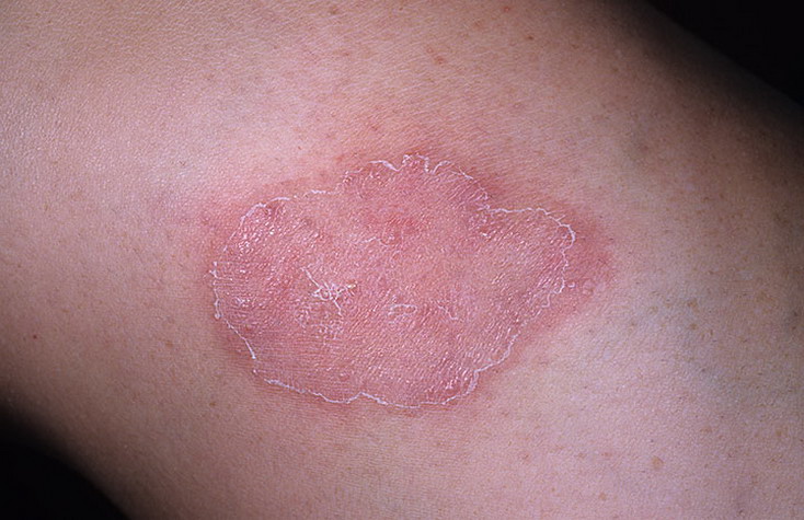 Грибковые болезни кожи