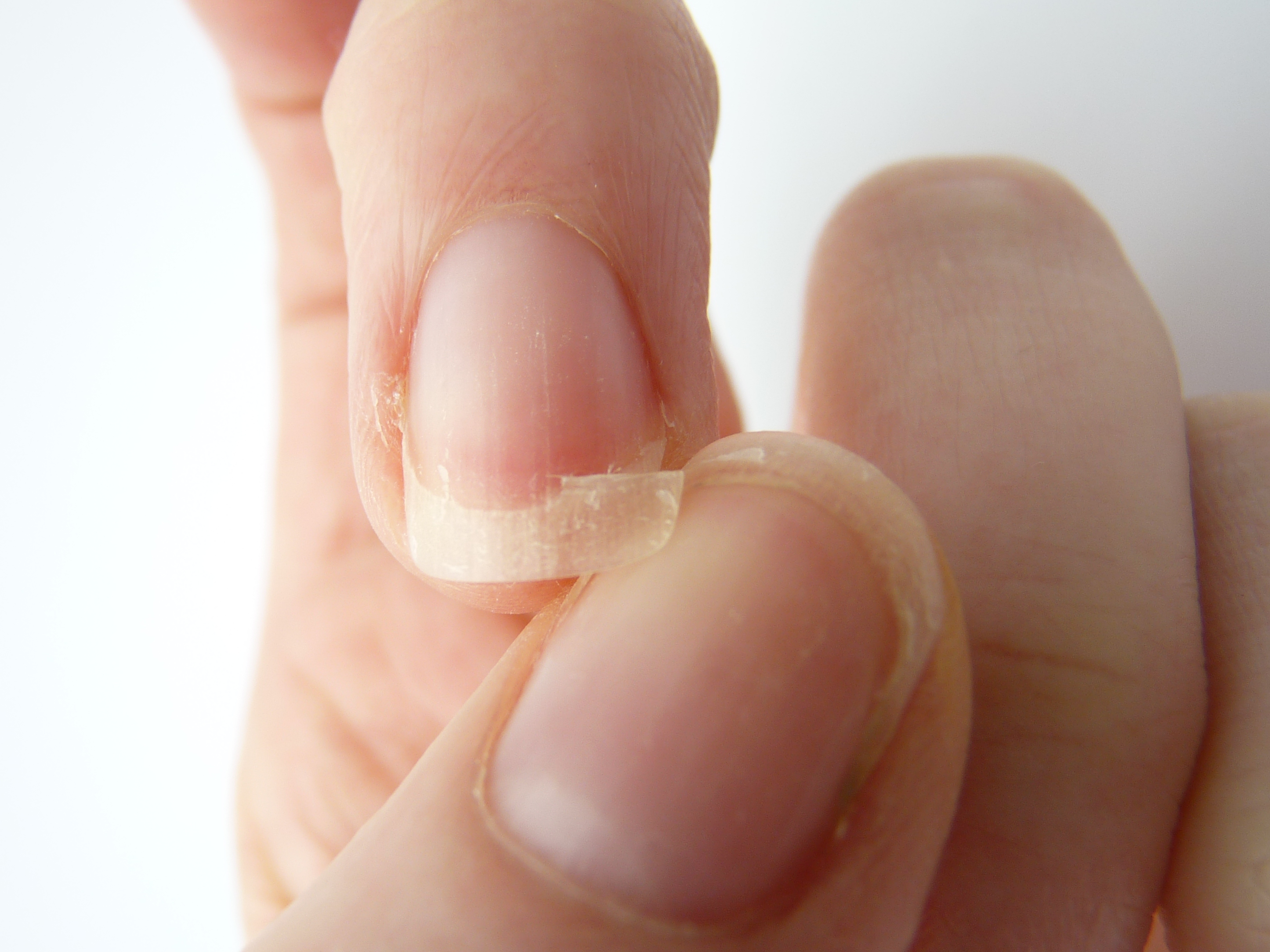 Проблемы ногтевых пластин