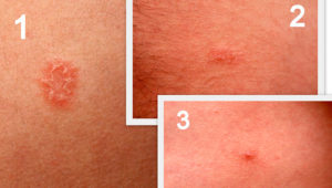 Проявления сифилиса на коже