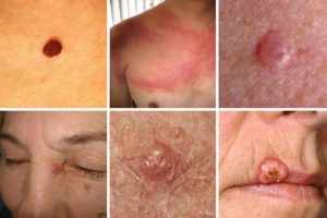 Особенности развития рака кожи