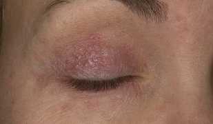 Особенности заболевания псориаз на веках и вокруг глаз