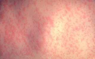Особенности развития недуга Аллергический псориаз