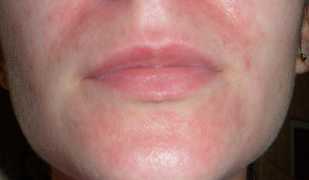 Причины развитие и способы лечения псориаза на лице
