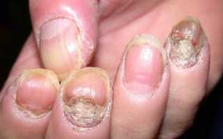 Серьезное дерматологическое заболевание — псориаз ногтей
