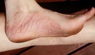 Методики лечения заболевания псориаз на ногах