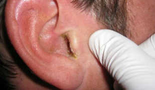 Почему возникает и как проявляется псориаз в ушах?