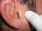 Почему возникает и как проявляется псориаз в ушах?