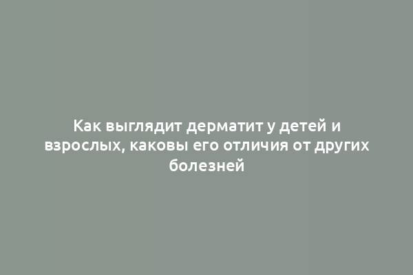 Как выглядит дерматит у детей и взрослых, каковы его отличия от других болезней